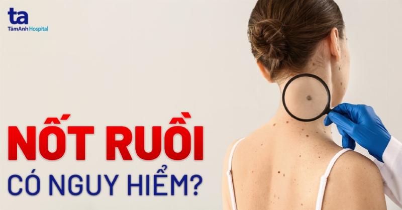 Phân loại nốt ruồi vùng kín nữ