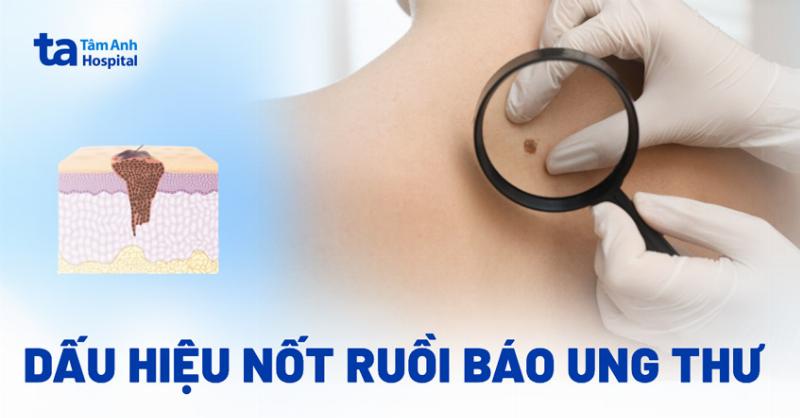 Dấu Hiệu Nốt Ruồi Vùng Kín Bất Thường