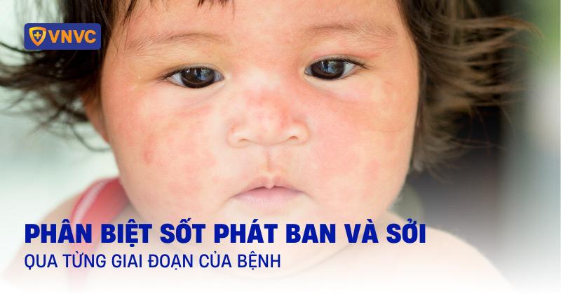 Hóa giải ảnh hưởng tiêu cực của sởi theo Tử Vi